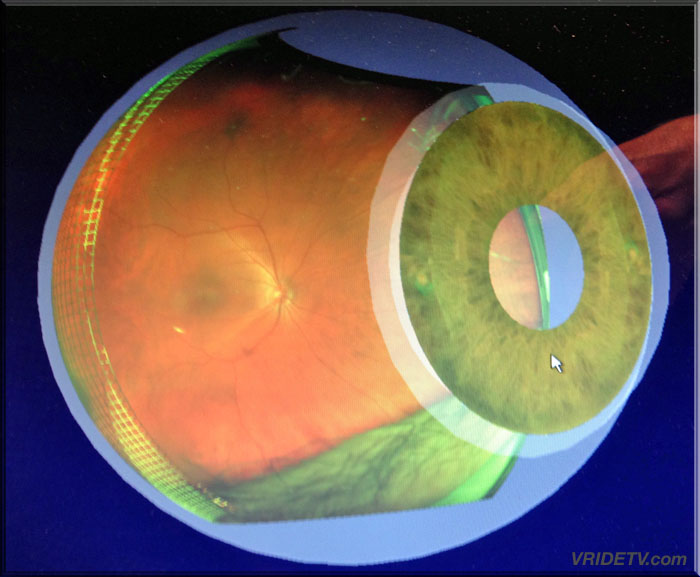EYEBALL with cataract VRIDETVcom